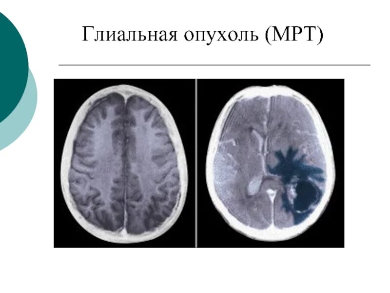 Опухоли глиального ряда на мрт. Глиальная опухоль головного