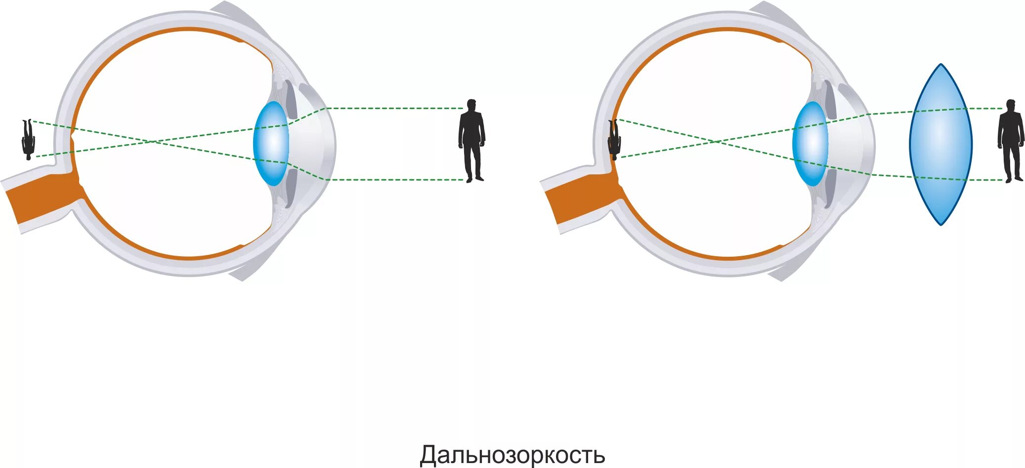 Линзы миопический астигматизм. Дальнозоркость и близорукость изображение глаза. Близорукость и дальнозоркость схема глаза. Дальнозоркость схема физика. Линзы для зрения дальнозоркость