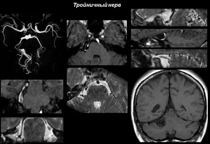 Мрт черепных нервов. Нейроваскулярный конфликт мрт невралгия тройничного нерва. Кт при невралгии тройничного нерва. Тройничный нерв мрт. Тройничный нерв на мрт головного мозга.