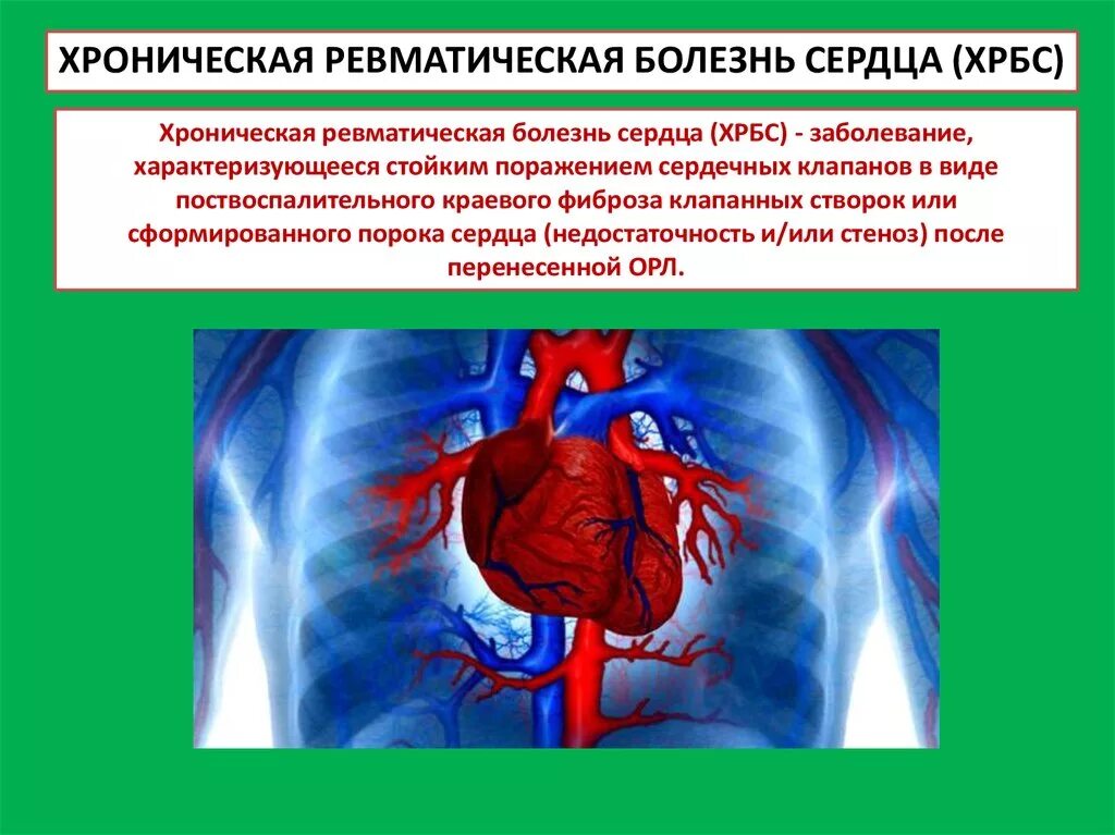 Ревматическая болезнь сердца клиника. Хроническая ревматическая болезнь сердца. Хроническая ревматическая болезнь сердца синдромы. Ревматизм хроническая ревматическая болезнь сердца.
