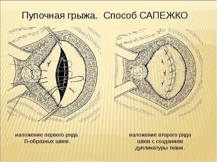 Пупочная грыжа методы операции