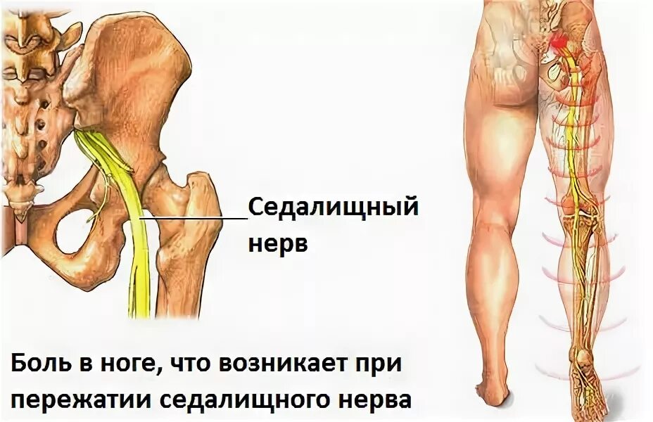 Как проявляется седалищный нерв симптомы. Нервно седалищный нерв. ишиас воспаление седалищного нерва. невропатия седалищного нерва клиника. метафизика седалищный нерв.