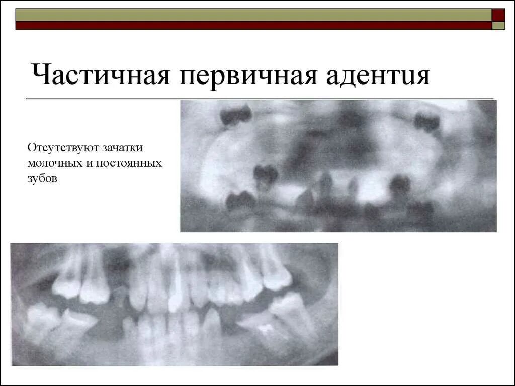У ребенка нет зачатка постоянного зуба