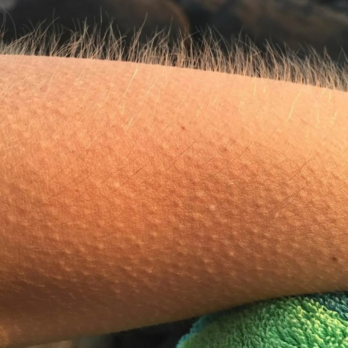 Фолликулярный кератоз ихтиоз. Фолликулярный кератоз («гусиная. Фолликулярный гиперкератоз. Фолликулярный кератоз гусиная кожа. Мурашки по спине бегают.