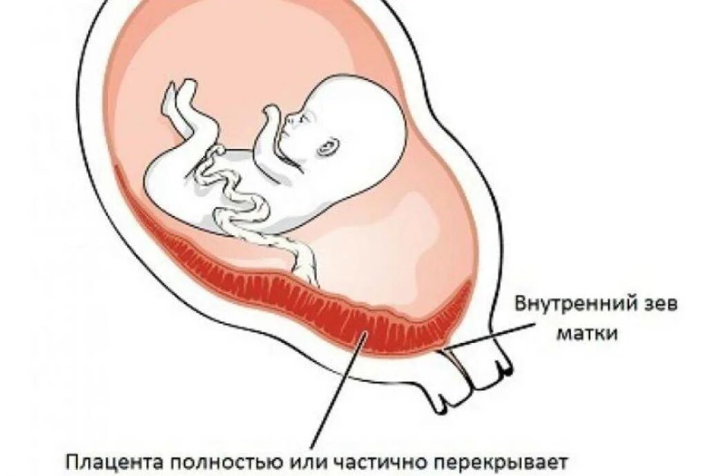 Маточный зев. Хорион плацента локализация передняя стенуи матки. Внутренний зев матки при беременности. Переднее предлежание плаценты при беременности.