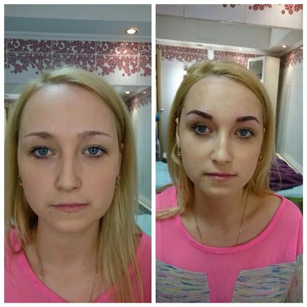 Шов после кесорево сеченич. Живот спустя месяц после родов. Через несколько месяцев после. Лапароскопия абдоминопластика. Кардио до и после.