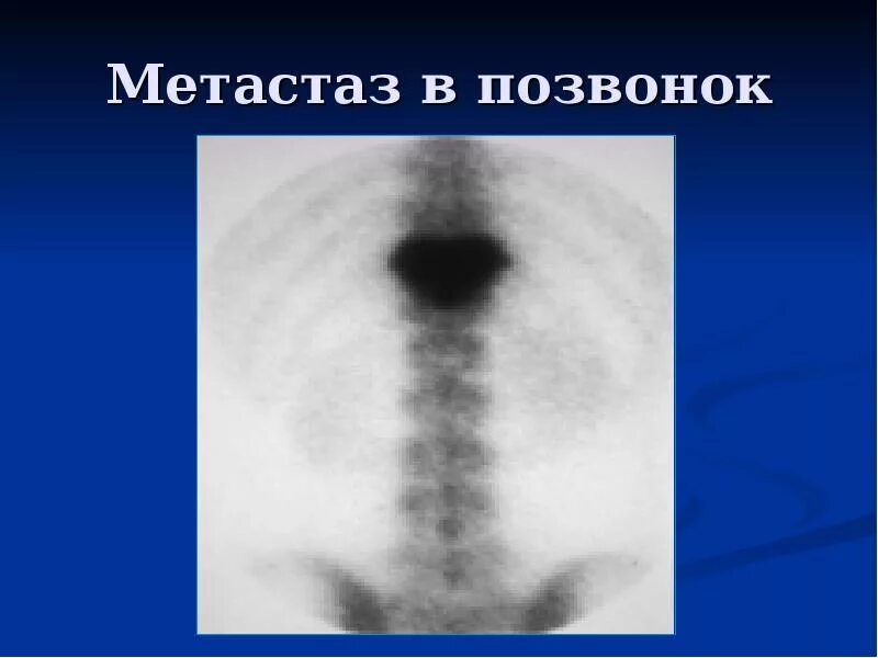 Метастазы у ребенка. Метастазы в позвоночнике рентген. метастазы позвонков рентген. метастазы в позвонки рентген. метастазы в позвоночнике рентгенограмма.