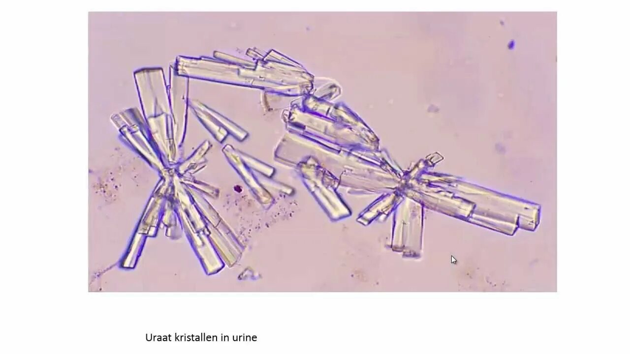 Иглы в моче. Кристаллы мочевой кислоты микроскопия. Струвиты микроскопия. Кристаллы мочевой кислоты под микроскопом. Микроскопия мочи Кристаллы мочевой кислоты.