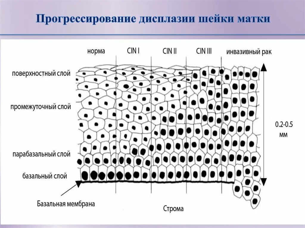 Изменение клеток матки. Дисплазия плоского эпителия. Многослойный плоский эпителий матки. Слизистая оболочка шейки матки гистология. Слои многослойного плоского эпителия шейки матки.