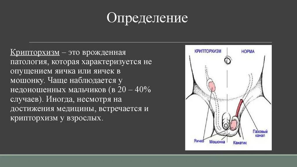 Крипторхизм паховая ретенция. Крипторхизм клиническая картина. Абдоминальный крипторхизм. Не опускаются яички что делать