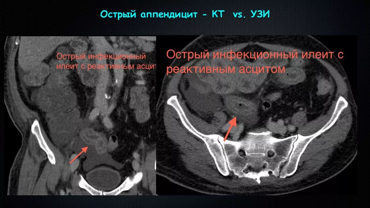 Аппендицит на узи можно ли. Острый аппендицит по узи.