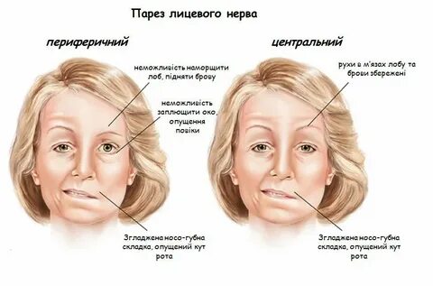 Парез