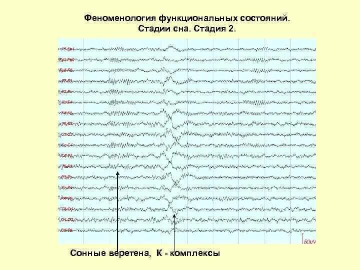 Веретена на ээг. Сонные веретена на ээг. Дэрд на ээг. Ээг головного мозга пароксизмальная активность. 1 фаза сна ээг.