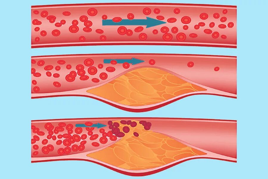 Атеросклероз холестериновая бляшка. Атеросклерозная бляшка сосуда. Атеросклероз (закупорка кровеносных сосудов). Ишемическая стадия атеросклероза. Тромб и бляшка разница