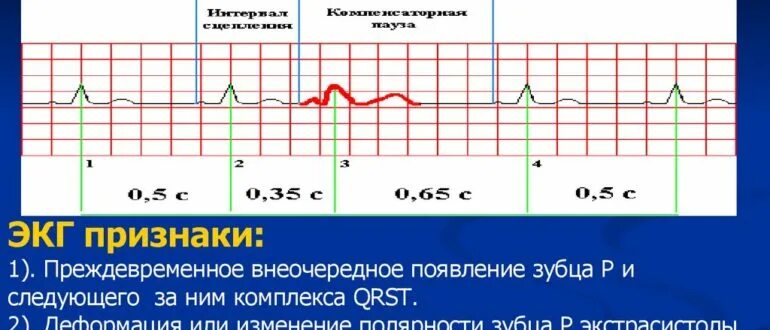 Норма экстрасистол в сутки. Желудочковая экстрасистолия норма в сутки. Экстрасистолы норма в сутки. Норма экстрасистол в сутки. Узловая экстрасистолия на экг.