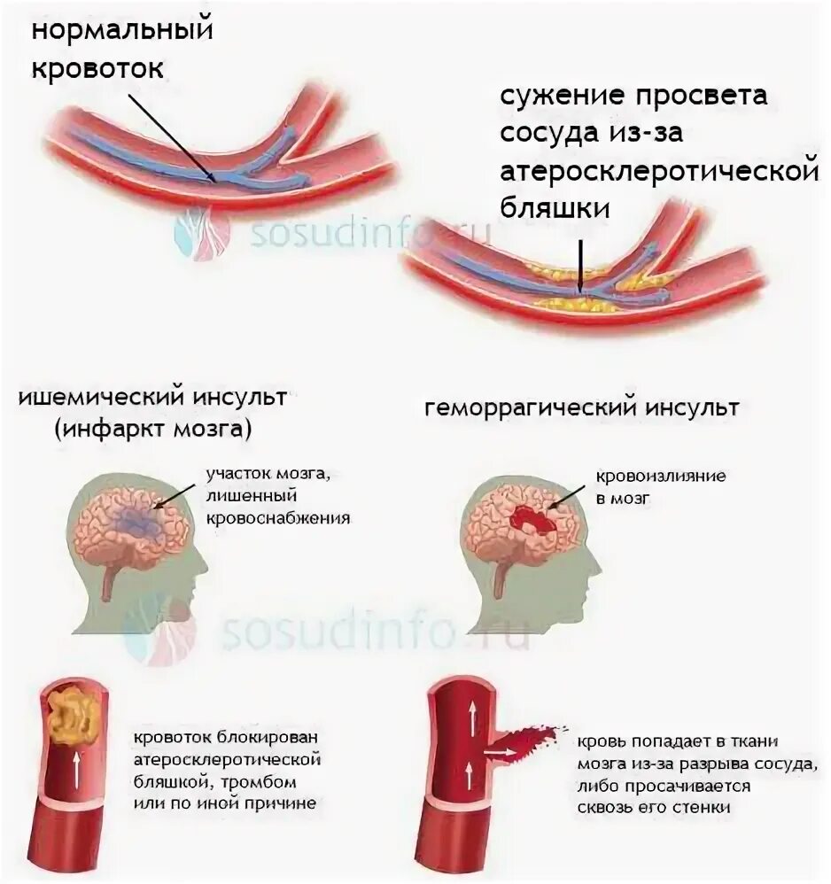 Почему сужаются сосуды