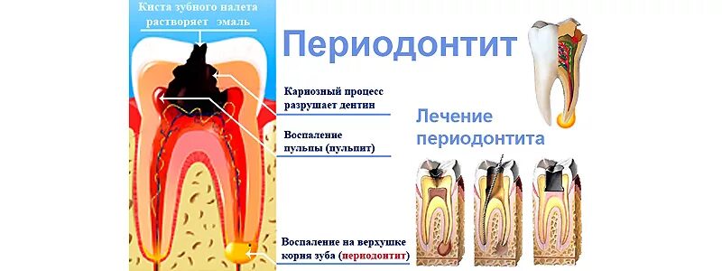 Классификация кариес пульпит периодонтит. Апикальный периодонтит. Периодонтит корня зуба. Периодонтит боковой стенки корня. Хронический гранулирующий периодонтит рентген.