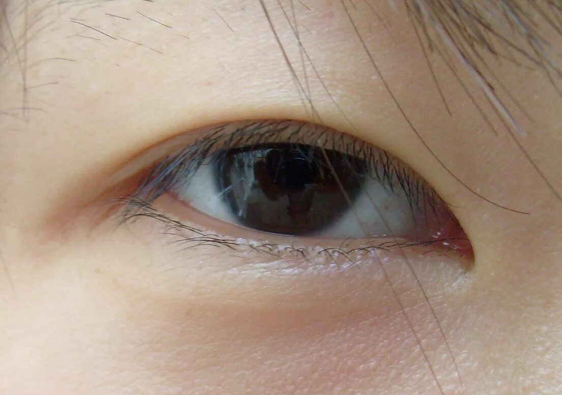 Глаз око веко. Эпикантус монгольская складка. Складка верхнего века эпикантус. Веко складка верхнее эпикантус. Эпикант, монголоидный разрез глаз.