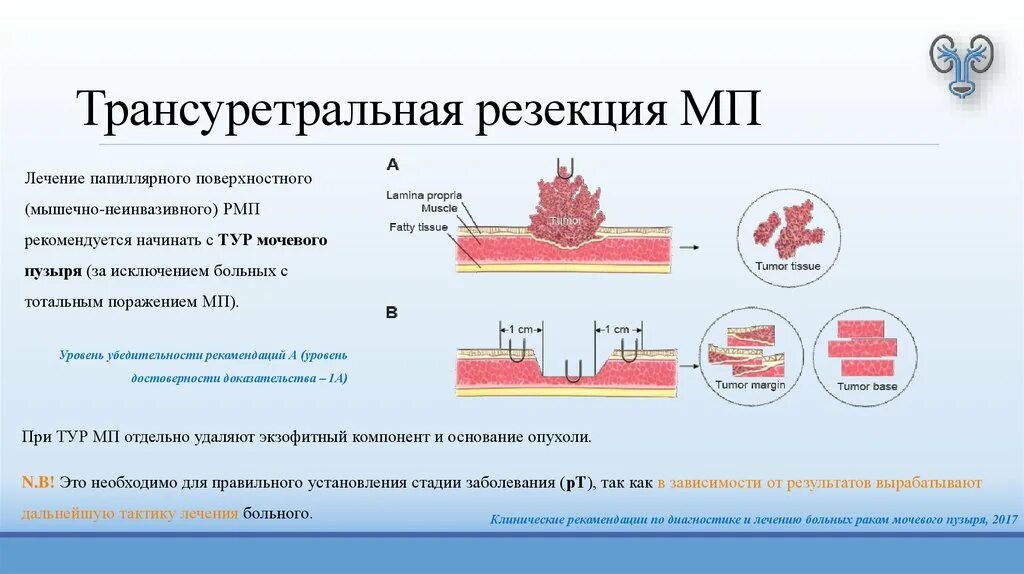 Моча после тур операции. Трансуретральная резекция простаты (Турп). Трансуретральная резекция ход операции. Трансуретральная резекция гиперплазии предстательной железы. Трансуретральной резекции мочевого пузыря.