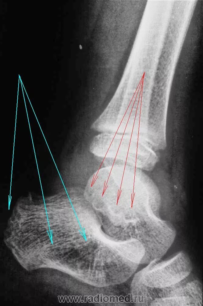 Рентген таранной кости норма. Остеосаркома пяточной кости рентген. Рентген пяточных костей в 2 проекциях. Рентген голеностопа норма снимок.