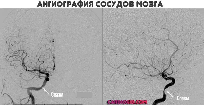 Почему спазм сосудов