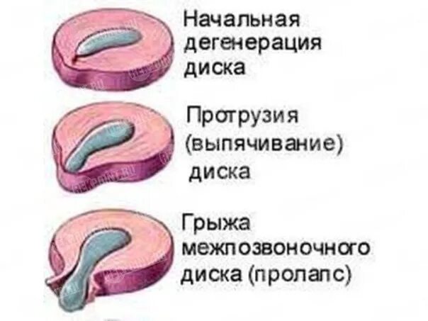 Протрузия это. Протрузия межпозвонковых дисков. циркулярная экструзия межпозвонкового диска. протрузия межпозвонковых дисков причины. выпячивание диска позвоночника.