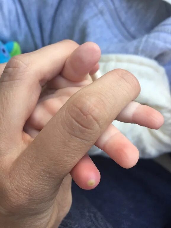 Пупырка на пальце. Гнойник на пальце у ребенка. Панариций на подушечке пальца.