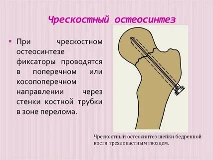 Остеосинтез это