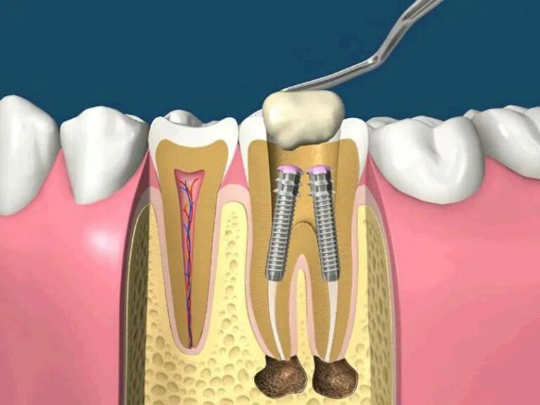 Root canal. Анкерный штифт в стоматологии. Стекловолоконный штифт в стоматологии.