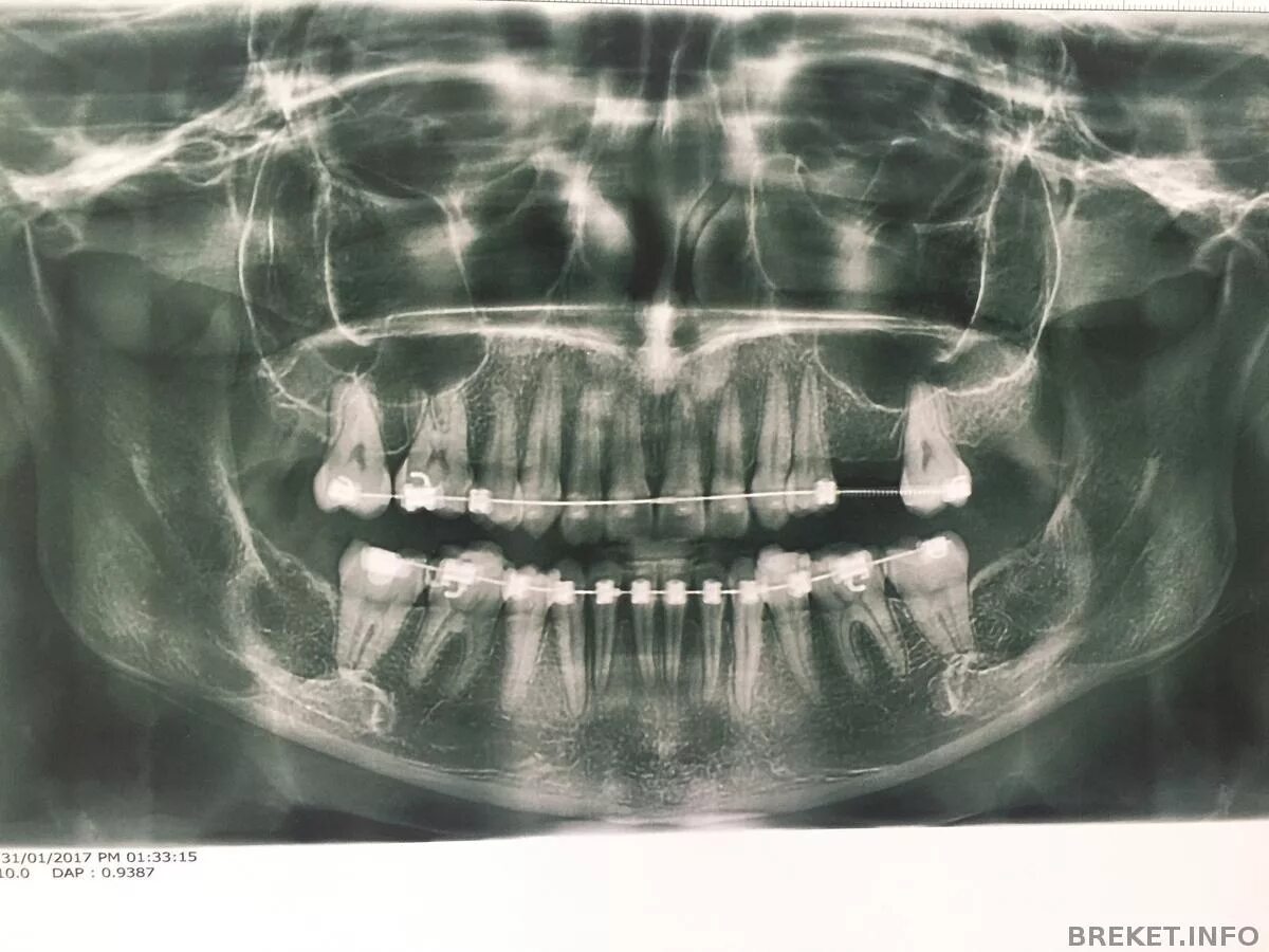 Снимок зубов видное. Ортопантомограмма (ОПТГ) (~0,013 м3 в).