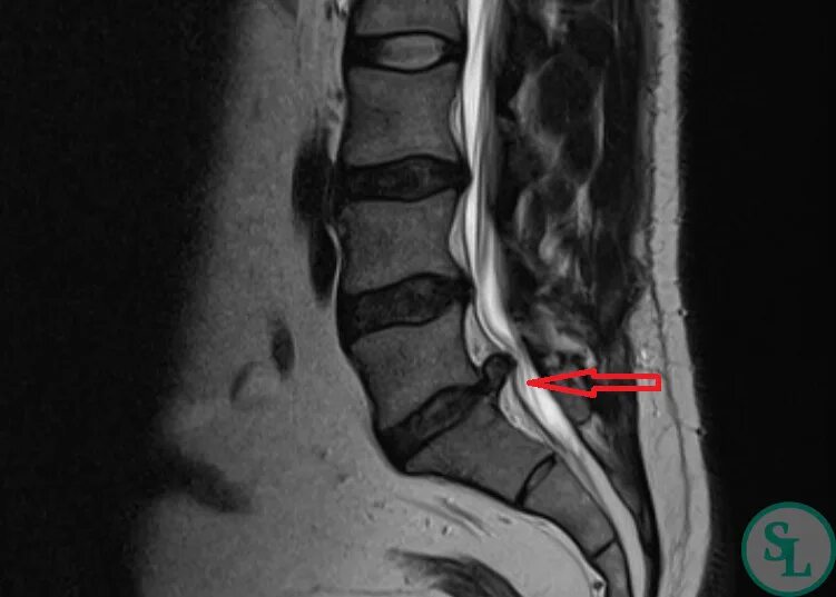 L4 l5 отдел позвоночника протрузия. Грыжа диска позвоночника l5 s1. Грыжа диска l5-s1. Диски l5-s1 в позвоночнике. Протрузия l5-s1.