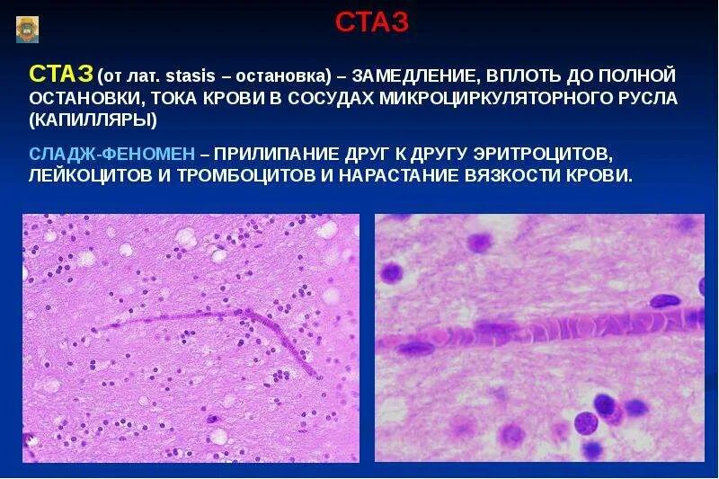 Признаки микро. Микропрепарат стаз в капиллярах головного мозга описание. Стаз сосудов патологическая анатомия. Стаз в сосудах головного мозга микропрепарат.