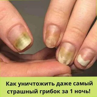 Чем лечить онихолизис ногтей отзывы