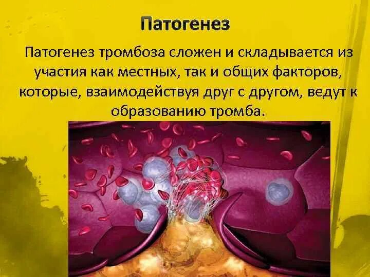 Патогенез образования тромба. Этиология тромбоза. Патогенез тромбообразования. Патогенез флеботромбоза. Механизм тромбоза