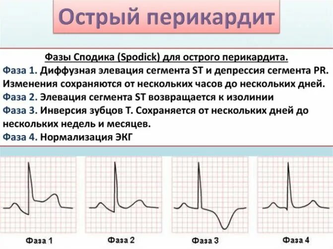 Депрессия сегмента st. Сегмент St на ЭКГ на изолинии. Элевация сегмента St на ЭКГ перикардит. Сегмент St на ЭКГ отображает. Элевация St при перикардите.