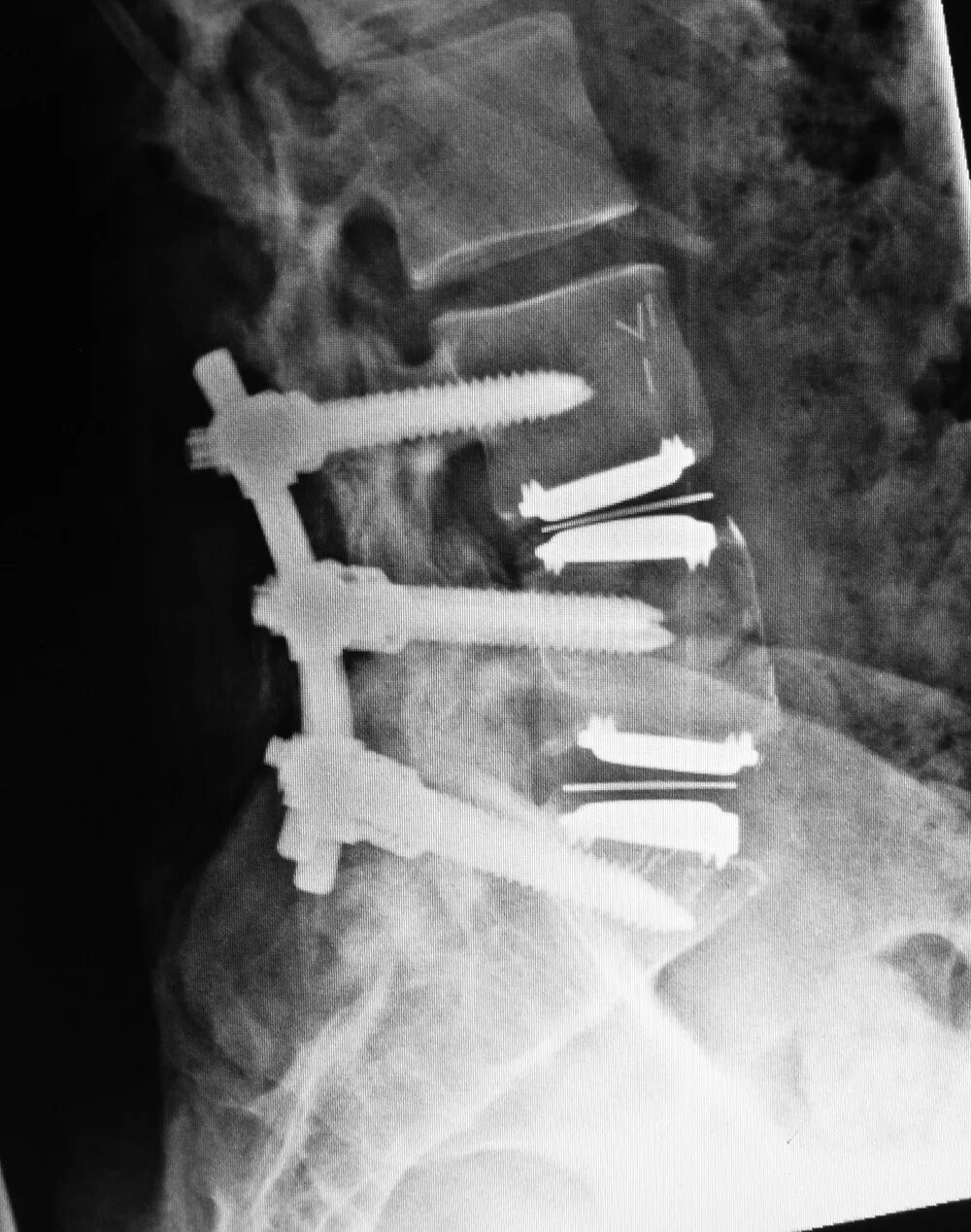 Операция на дисках позвоночника. Транспедикулярная фиксация позвоночника l4-l5. Транспедикулярная фиксация l5-s1 позвонков. Транспедикулярная фиксация l5-s1.