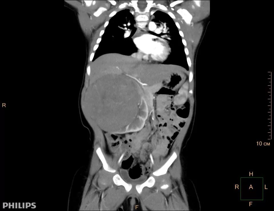 Нефробластома почки кт. Нефробластома у детей кт. Детские опухоли