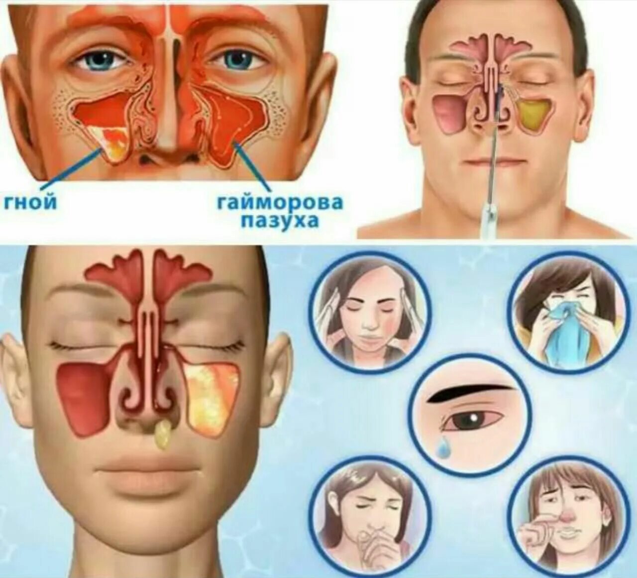 Сколько лечат гайморит. Гайморит фронтит этмоидит. Носовые и гайморовы пазухи. Носовая пазуха и гайморова пазуха.