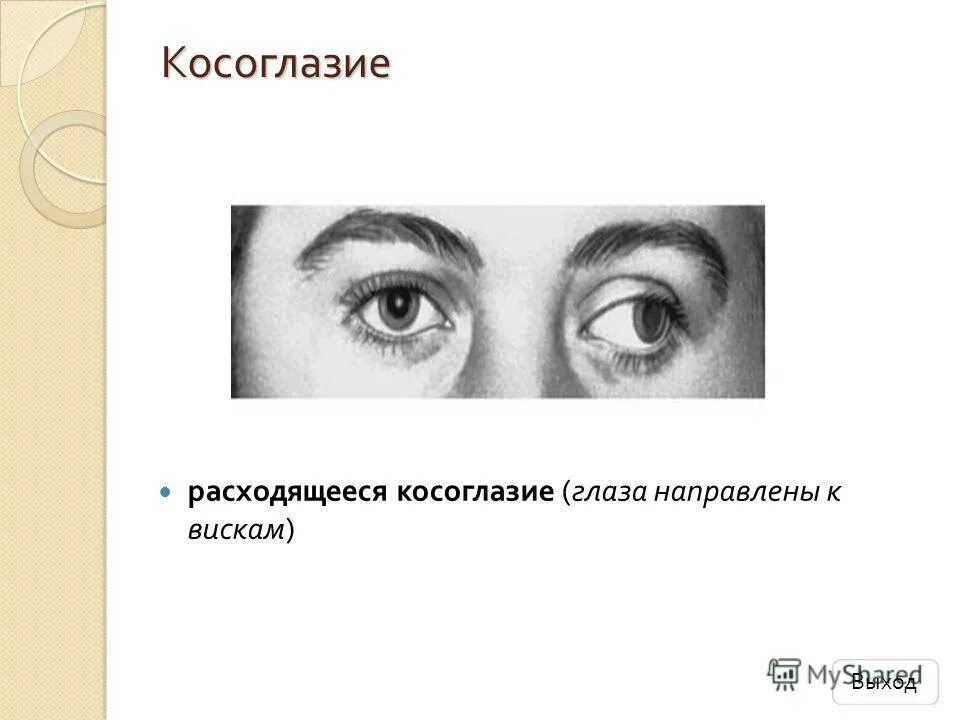 Небольшое косоглазие. Расходящееся косоглазие код. Поперечное косоглазие. Сходящееся содружественное косоглазие. Расходящиеся косогдазие.