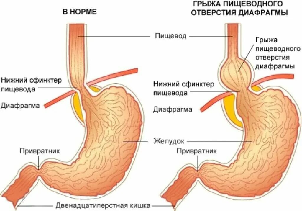 Грыжа кардии