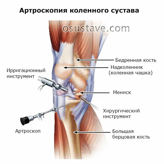 Анатомия коленного сустава пункция. Артроскопия ПКС коленного сустава. Артроскопия коленного мениска. Артроскопия связки надколенника. Операции на коленном суставе стоимость