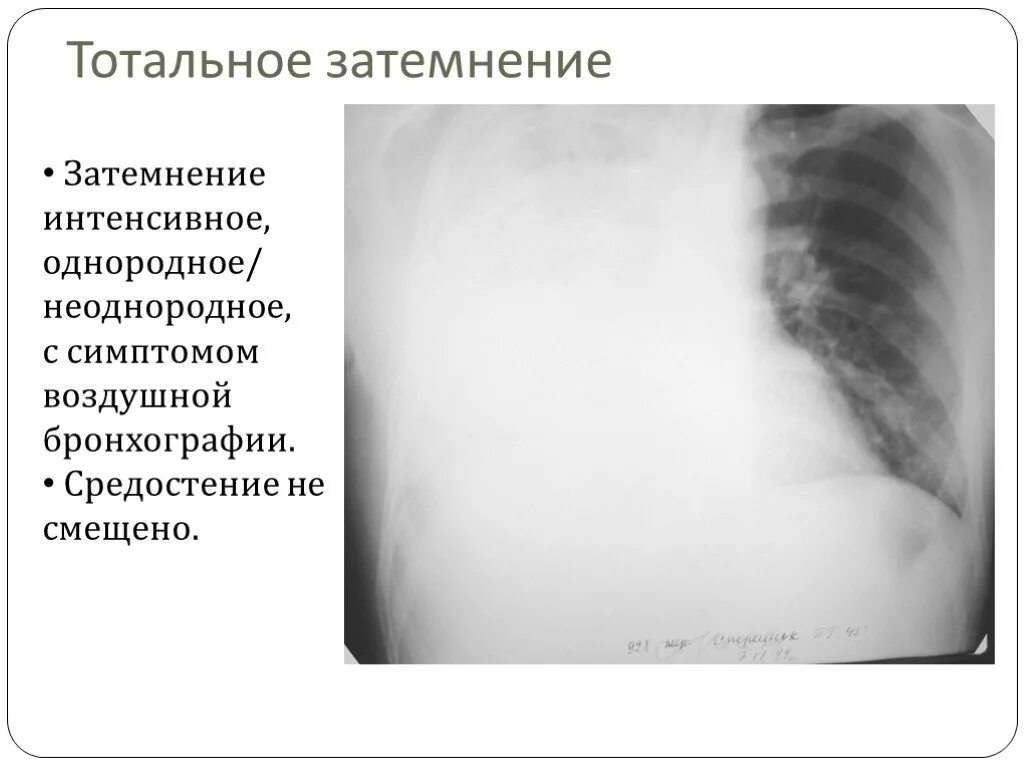 Как ты понимаешь что такое затемнение. Рентген тотальное затемнение легкого. тотальный гидроторакс рентген. тотальная пневмония рентген. тотальное и субтотальное затемнение легочного поля.