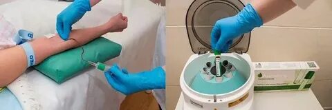 Плазмолифтинг сколько надо процедур