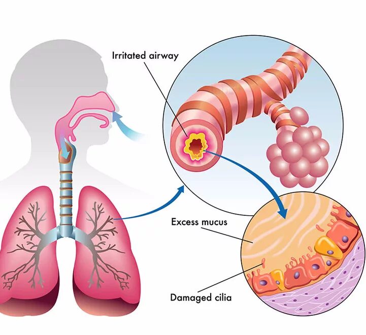 Кашель с мокротой 10 лет. Заболевания органов дыхания хронический бронхит. Поражение бронхов острый бронхит. Хронический бронхит симптомы дыхание.