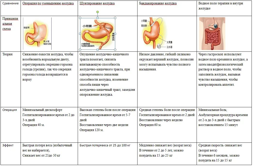Последствия операции желудка. Продольная резекция желудка после операции. Уменьшение объема желудка операция. После операции по уменьшению желудка. Операция на желудок для похудения.