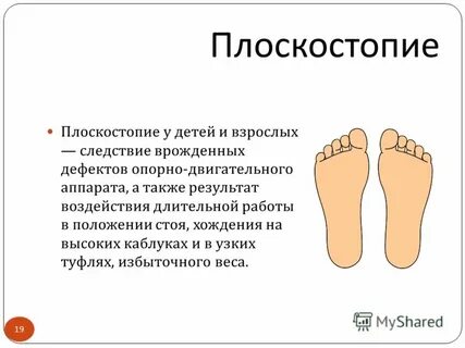 Плоская стопа мкб 10 у детей