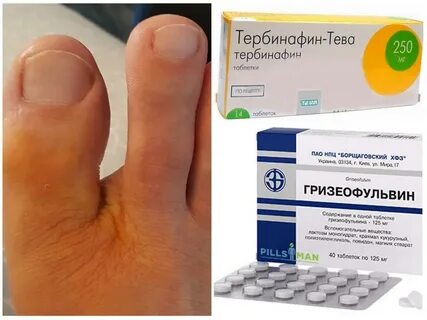 Лечение грибка у женщин препараты