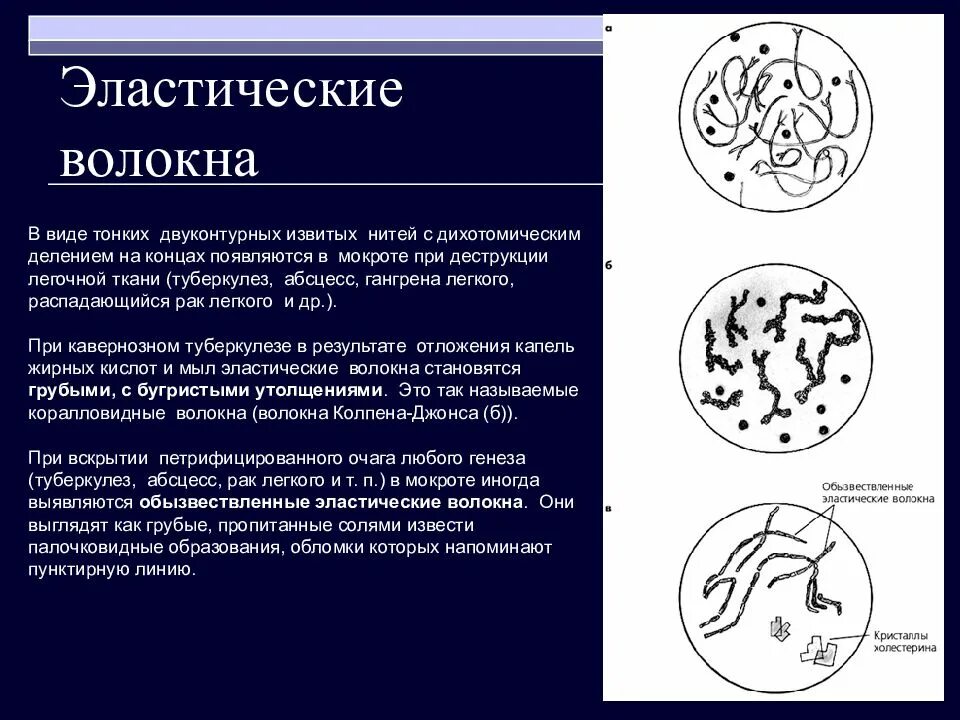 В мокроте можно обнаружить. Эластические волокна в мокроте микроскопия. Эластические волокна обнаруживают в мокроте при:. Эластические волокна в мокроте при. Коралловидные эластические волокна в мокроте.