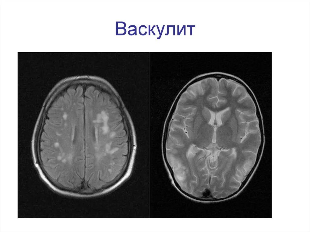 Поражение белого вещества мозга. Очаги поражения головного мозга рассеянный склероз.