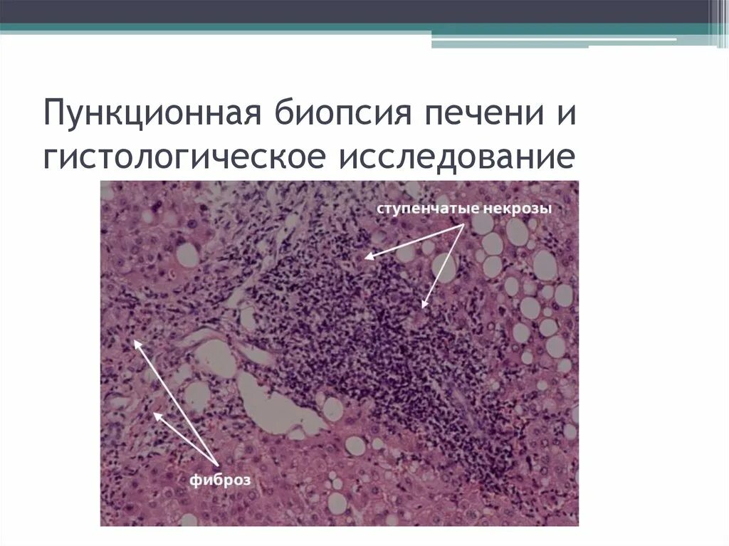 Биопсия печени после биопсии. Гистологические исследование биоптата печени. Перкутанная биопсия печени. Карцинома печени гистология. Пункционная биопсия печени гистология.